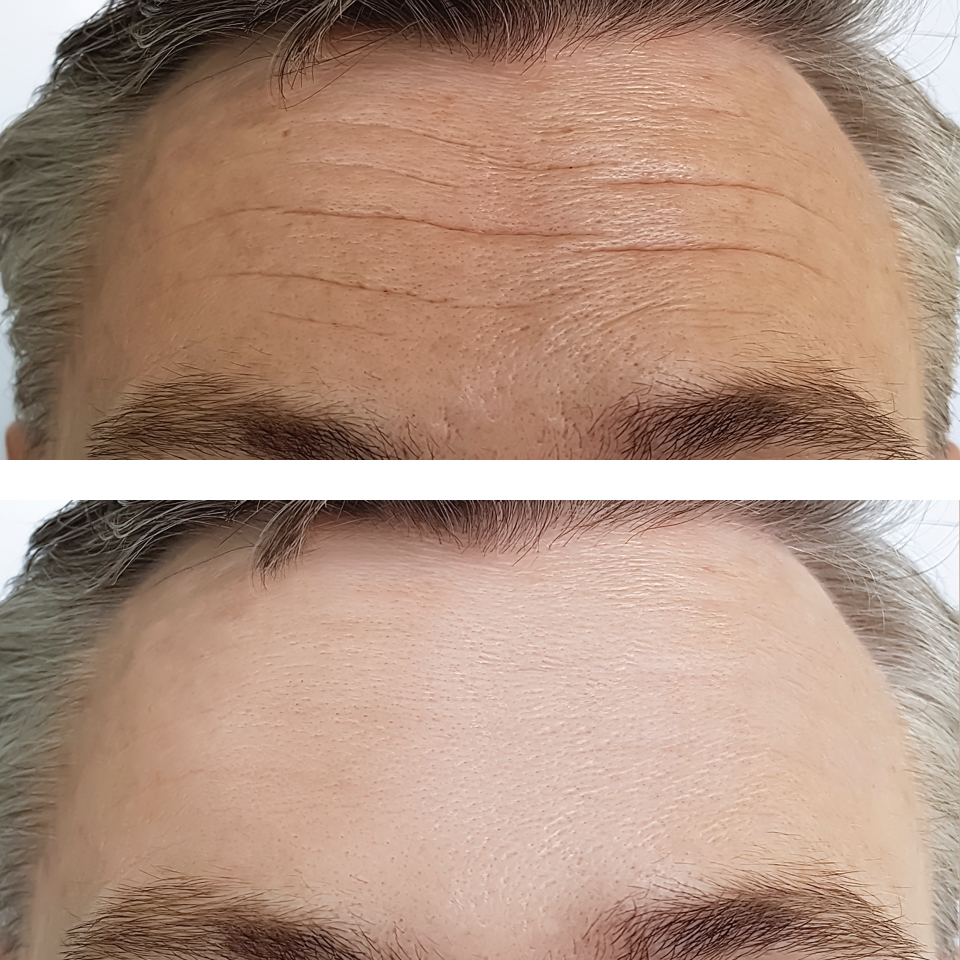 A before and after shot of a mans forehead for anti-wrinkle treatment
